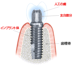 インプラントの構造