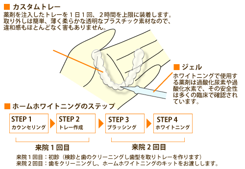 ホームホワイトニングの手順